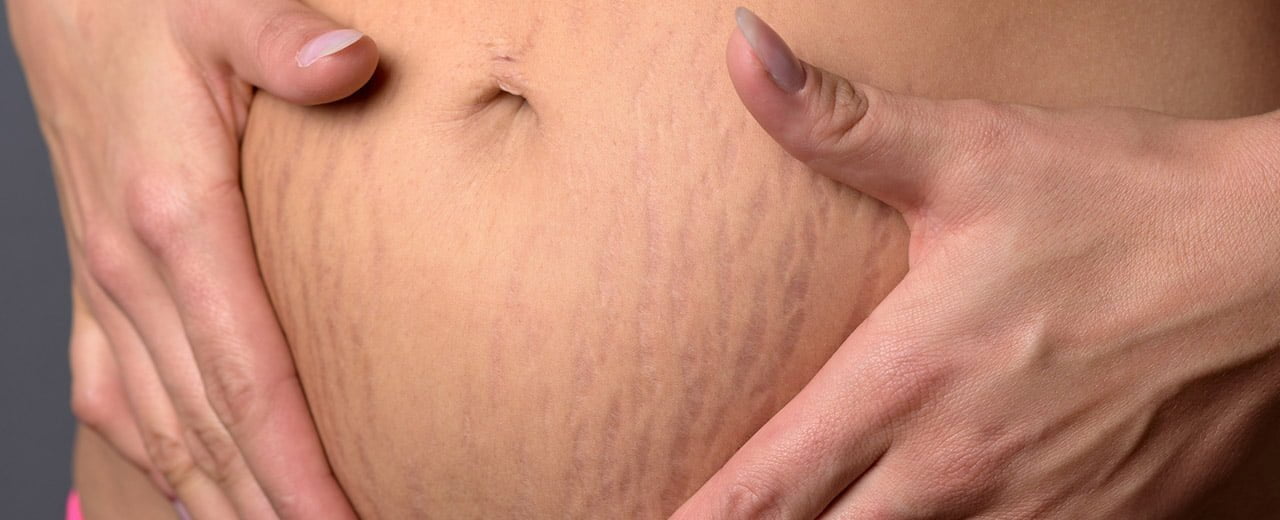 Những vết rạn da sau sinh do thai kỳ