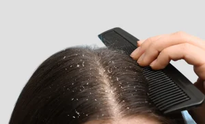 Nguyên nhân phổ biến gây ra tình trạng gàu