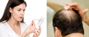 Bị rụng tóc