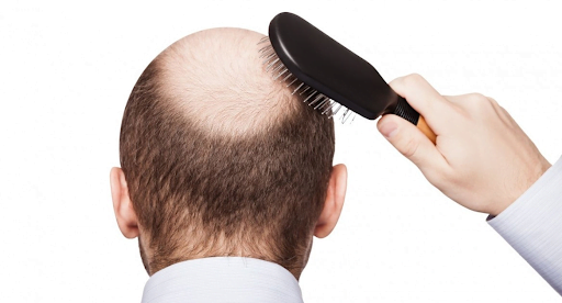 Rụng tóc nhiều gây ra hói đầu