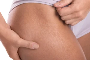 Da xuất hiện các vết rạn