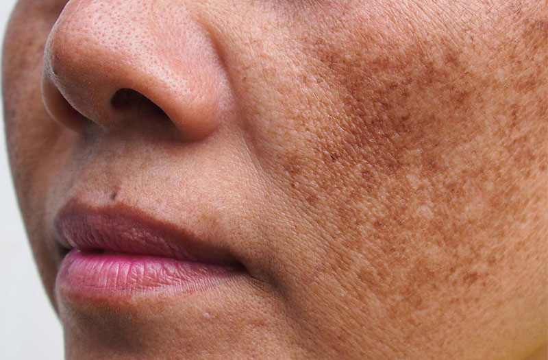 Lưu ý khi sử dụng viên uống trắng da mờ nám tàn nhang