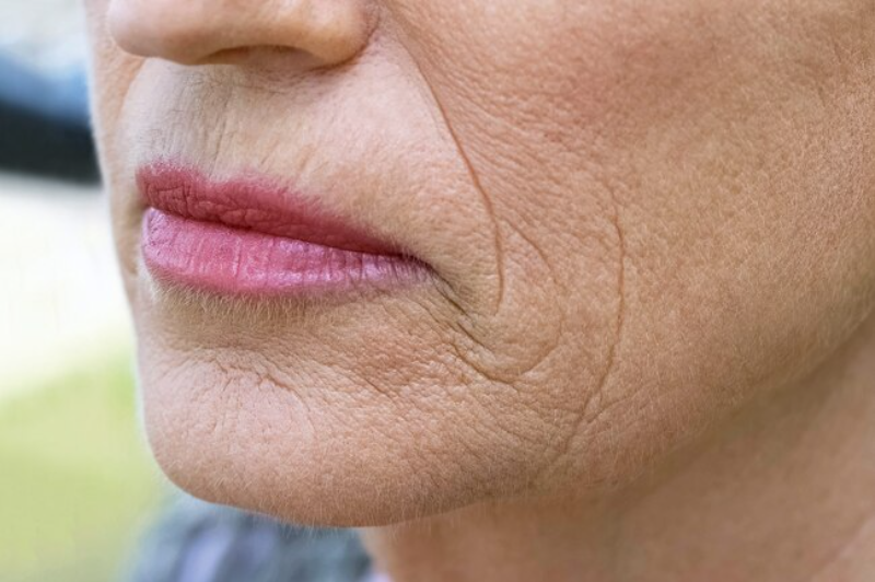 Xuất hiện nếp nhăn và rãnh nhăn