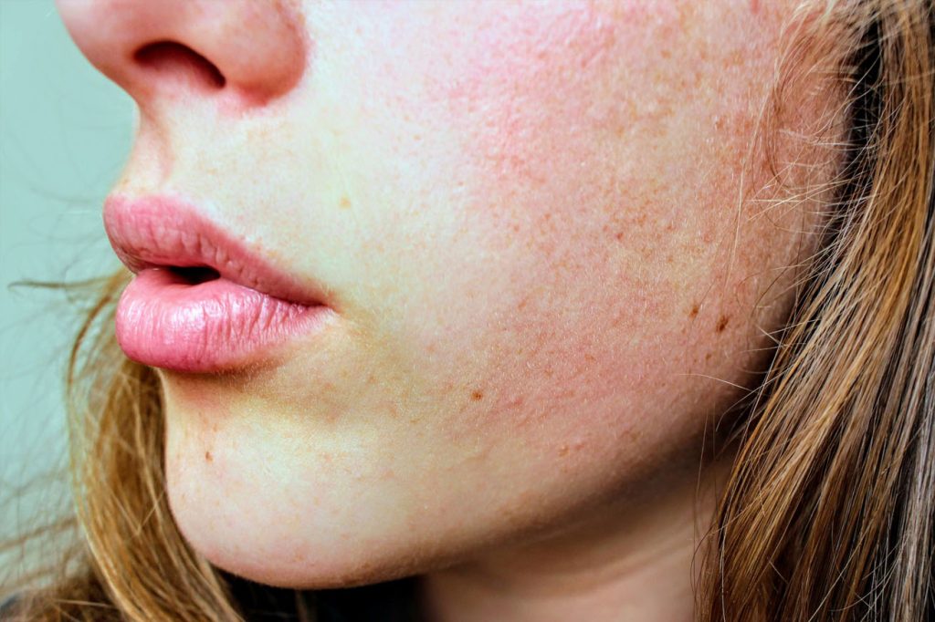 Da quá khô phải làm sao