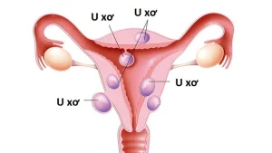 U xơ tử cung
