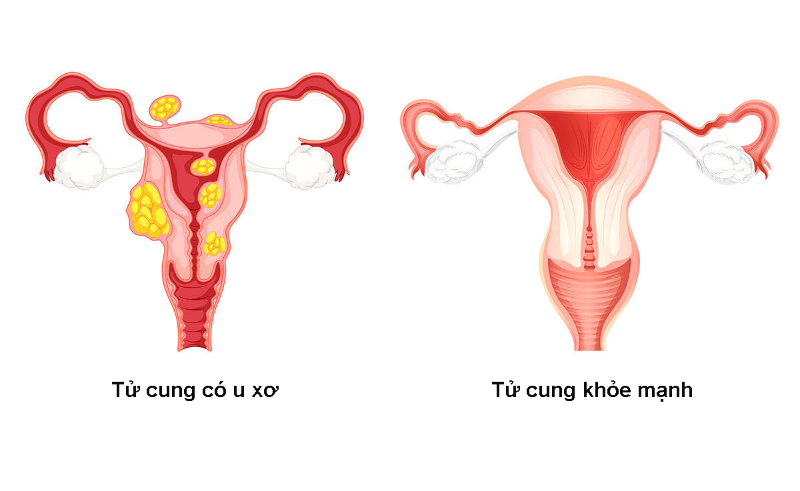 U xơ tử cung và tử cung bình thường