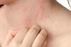 uống vitamin e có bị nổi mụn không
