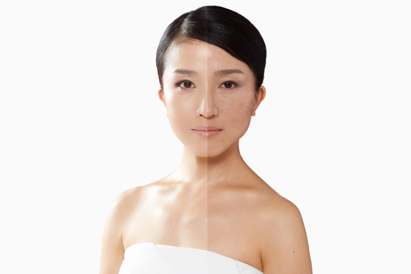 Viên Uống Trị Nám Của Nhật Loại Nào Tốt? So Sánh Loại Của Mỹ? 3 tầm quan trọng của việc trị nám da