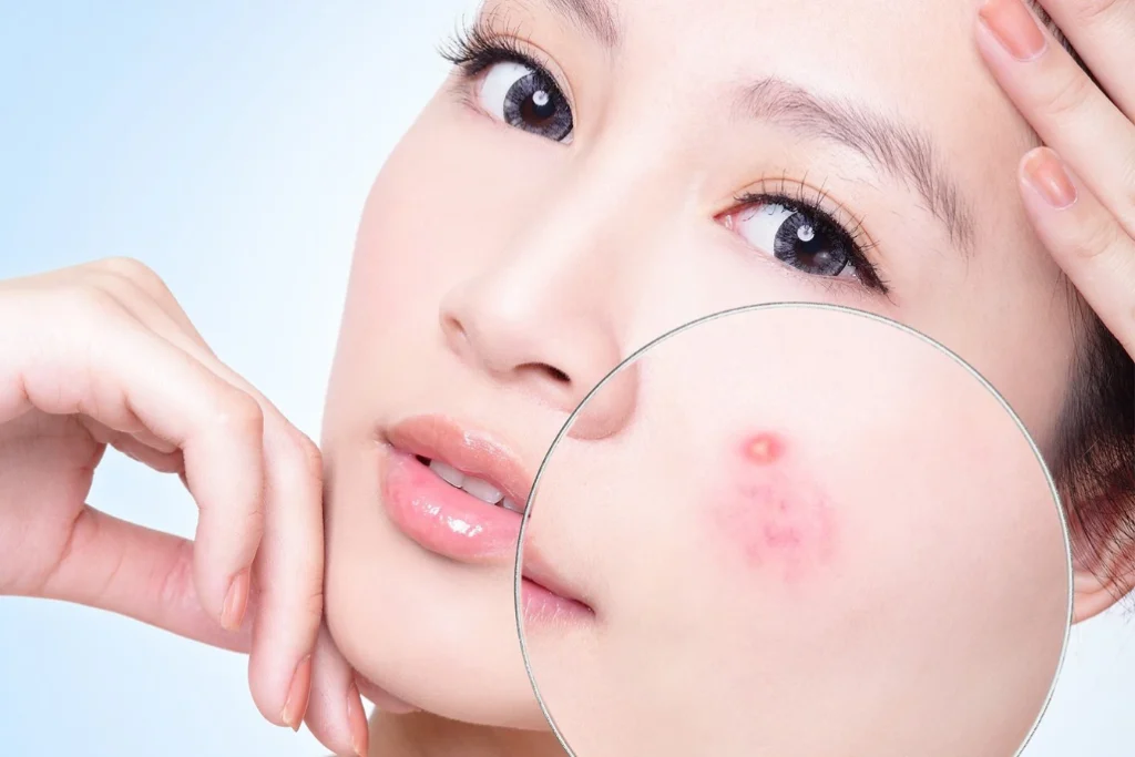 Collagen Nào Tốt Cho Da Mụn? Top 7 Sản Phẩm Hiệu Quả Nhất 1 collagen nào tốt cho da mụn