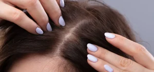 Một số dấu hiệu của tình trạng nang tóc yếu