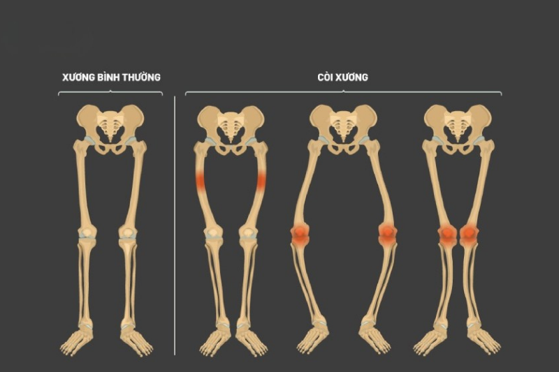 Nguyên nhân và cách khắc phục tình trạng thiếu vitamin D 7 Còi xương hoặc biến dạng xương ở trẻ