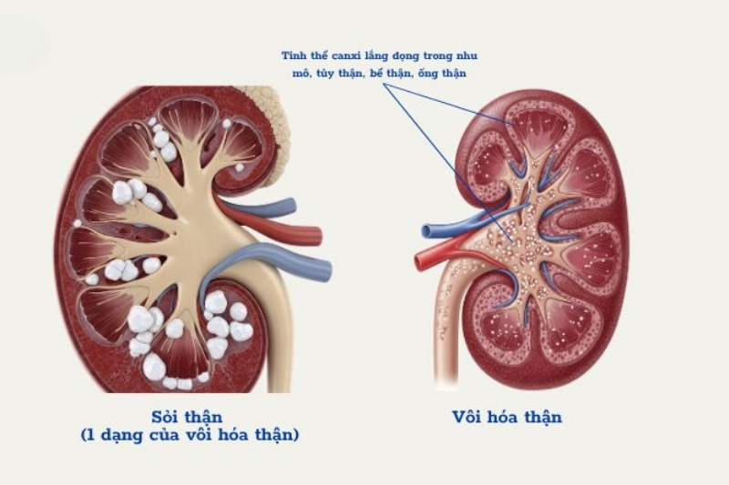 Những dấu hiệu và tác hại khi bổ sung thừa vitamin D 7 Lắng đọng canxi ở thận