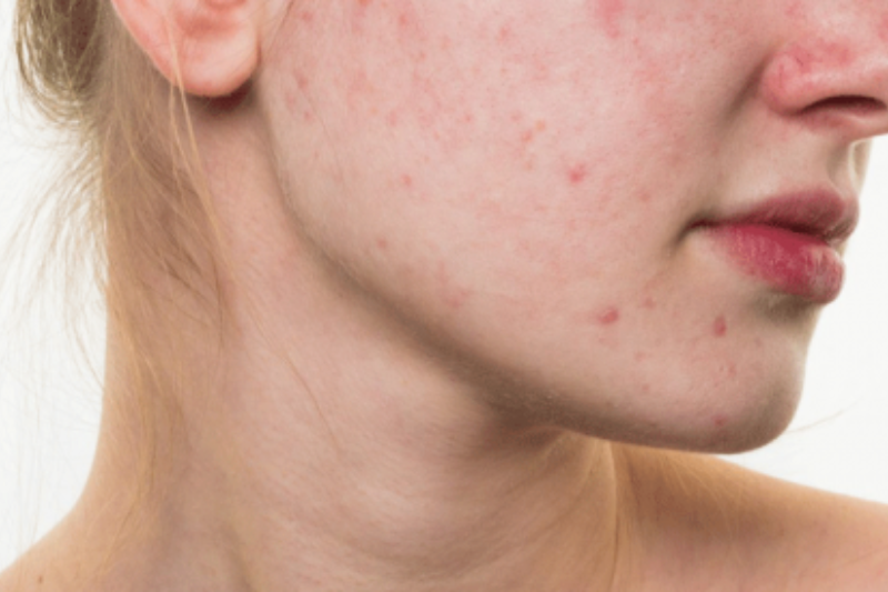 Vì Sao Uống Vitamin C Bị Nổi Mụn Và Cách Xử Lý Hiệu Quả 3 Da dầu hoặc đang có mụn cũng khiến việc uống vitamin C bị nổi mụn