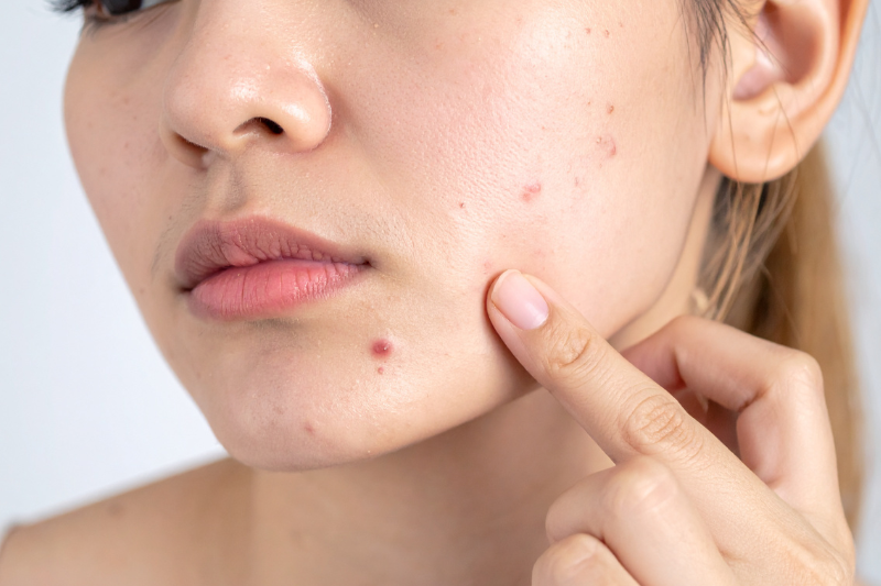 Giải thích nguyên nhân uống vitamin C bị nóng trong 3 Nổi mụn li ti khi uống vitamin C