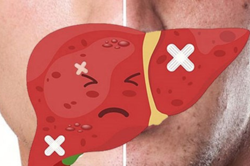 Những ai không nên uống omega 3? Người có vấn đề về gan nặng dễ bị xơ gan, suy gan, viêm gan..