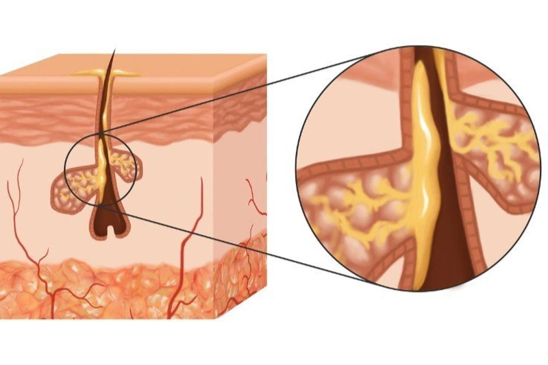 Tuyến bã nhờn ở nam giới hoạt động mạnh hơn