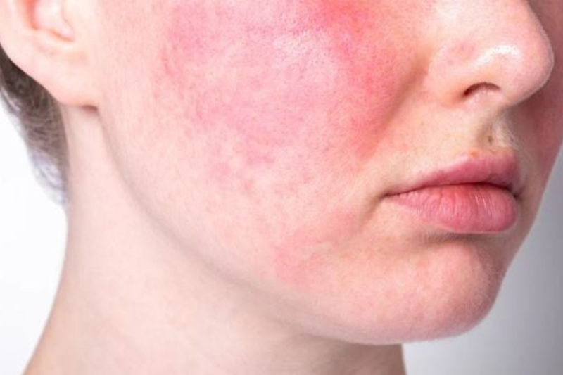 Quá trình chăm sóc da không phù hợp cũng khiến hàng rào bảo vệ da bị tổn thương