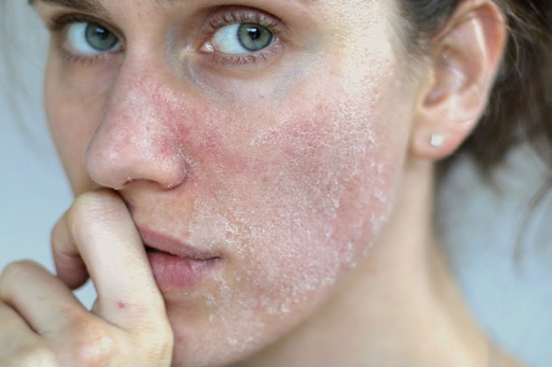 Da khô, bong tróc, thiếu độ đàn hồi cũng là dấu hiệu của việc hormone thay đổi