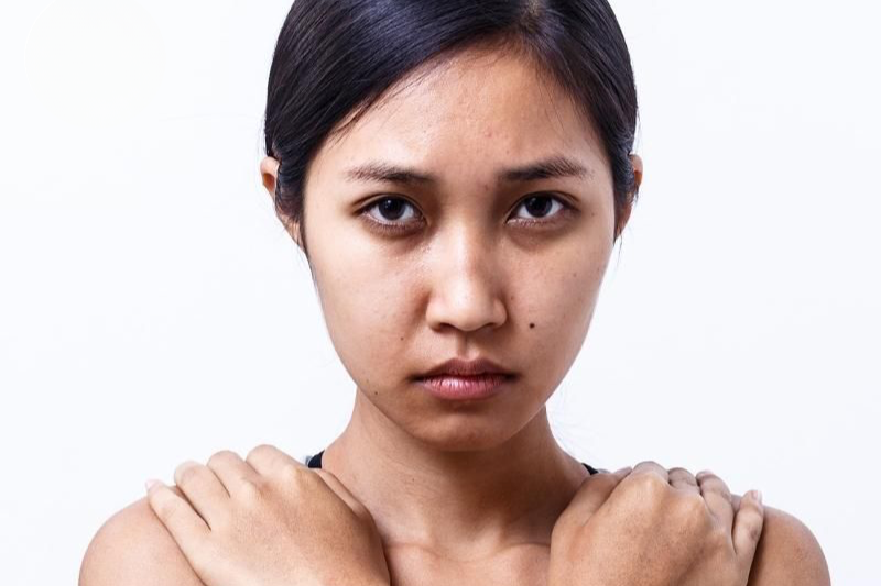 Da xỉn màu là tình trạng da mất độ sáng tự nhiên, không đều màu, da không mịn màng, thiếu sức sống