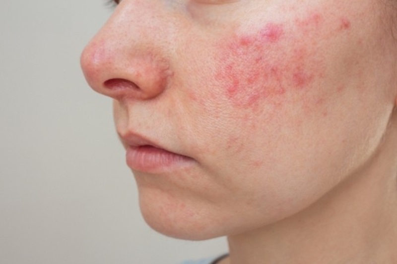 Dị ứng da là tình trạng cơ thể phản ứng gây ngứa, đỏ, nổi mẩn, sưng nhẹ