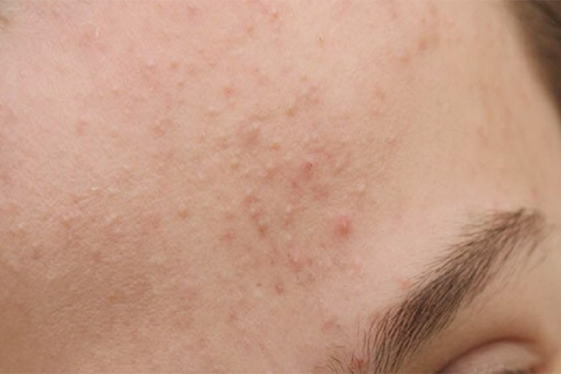 Da bị dị ứng nhẹ thường dễ bị bỏ qua