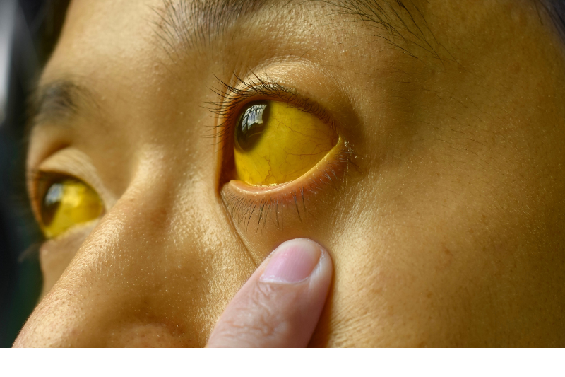 Chức năng gan suy giảm có thể gây vàng da bệnh lý