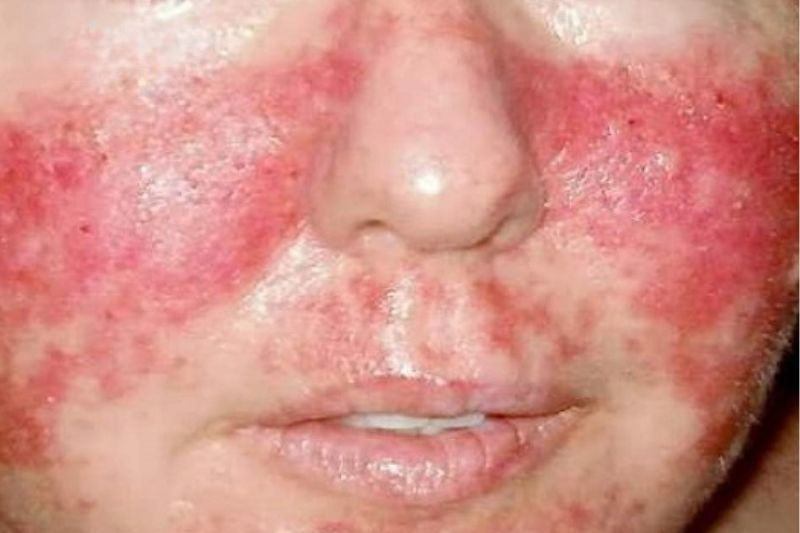 Khi da bị sưng nhiều hoặc lan sang vùng khác thì cần phải gặp bác sĩ 