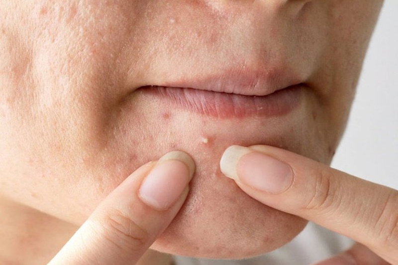 Không nên tự ý nặn mụn tránh trường hợp bị viêm, lan rộng hoặc để lại sẹo lâu dài