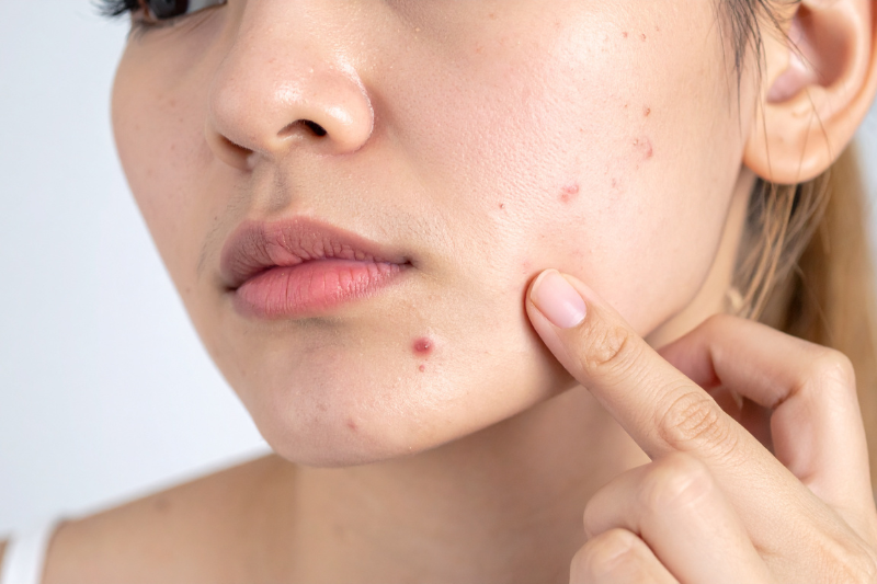 Tình trạng mụn trứng cá cũng liên quan đến hệ tiêu hóa