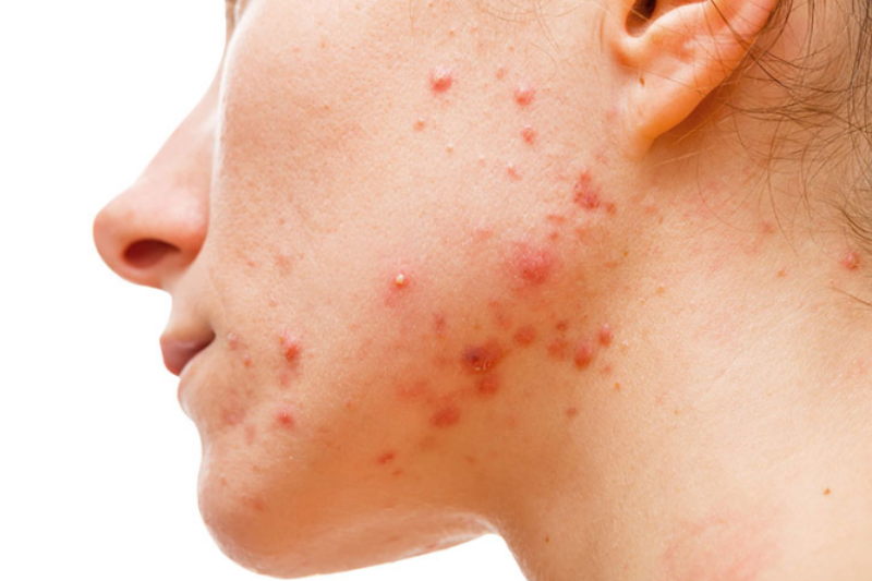 Mụn nội tiết gây viêm, sưng là dấu hiệu của việc nội tiết tố ảnh hưởng đến da 