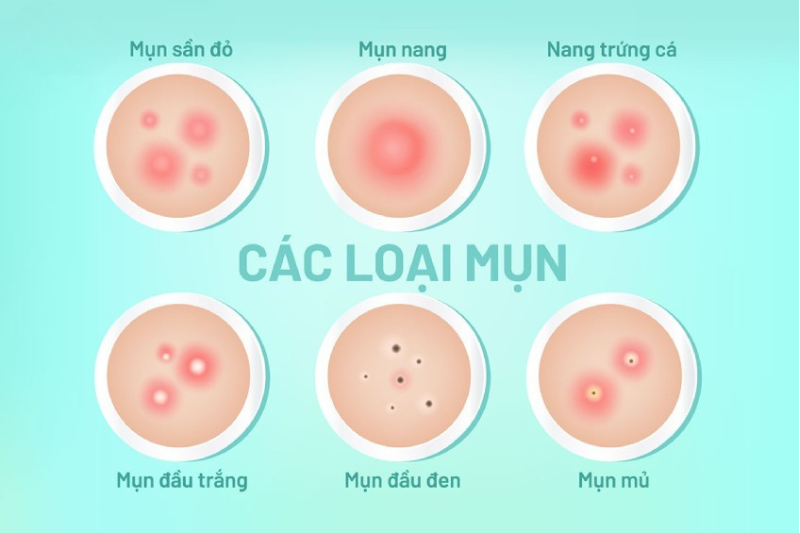 Mụn trứng cá thường gặp ở tuổi dậy thì nên cần chăm sóc da tuổi dậy thì đúng cách