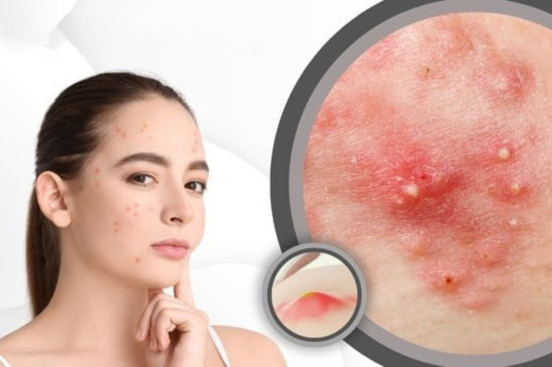 Mụn trứng cá là biểu hiện dễ thấy khi stress ảnh hưởng đến da