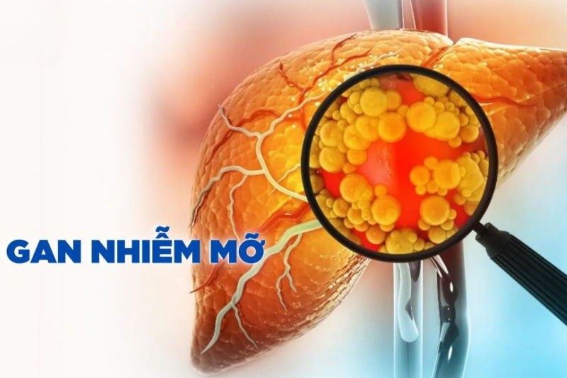 Nguyên nhân gây gan nhiễm mỡ đến từ chế độ ăn, lối sống và thừa cân