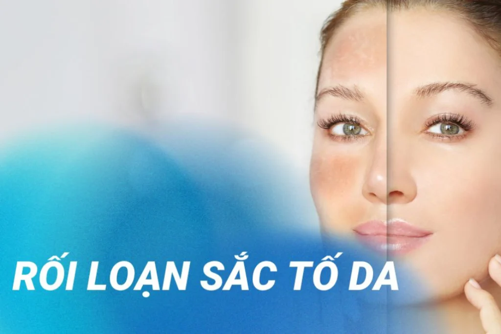 Rối loạn sắc tố da là gì? Cách kiểm soát để da đều màu và sáng khỏe hơn