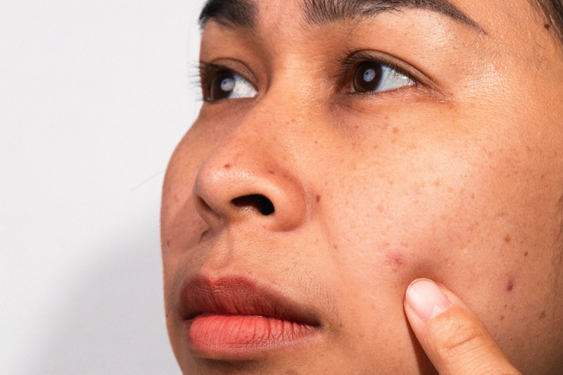 Tế bào chết tích tụ và thiếu ẩm sẽ khiến làn da của bạn bị xỉn màu