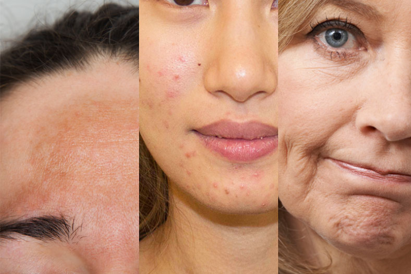 Nội tiết tố ảnh hưởng đến da ở tuổi tiền mãn kinh và mãn kinh khá rõ rệt