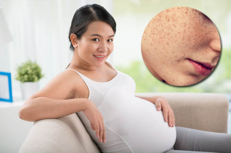 Giai đoạn mang thai da dễ nảy sinh tình trạng tăng sắc tố