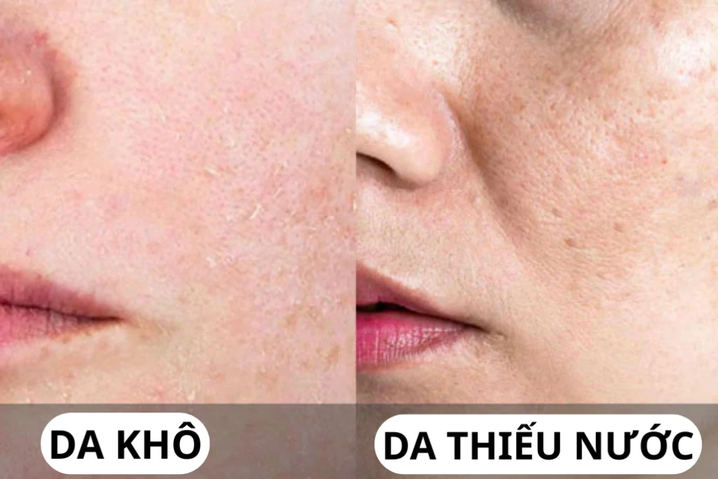 phan biet da kho va da thieu nuoc