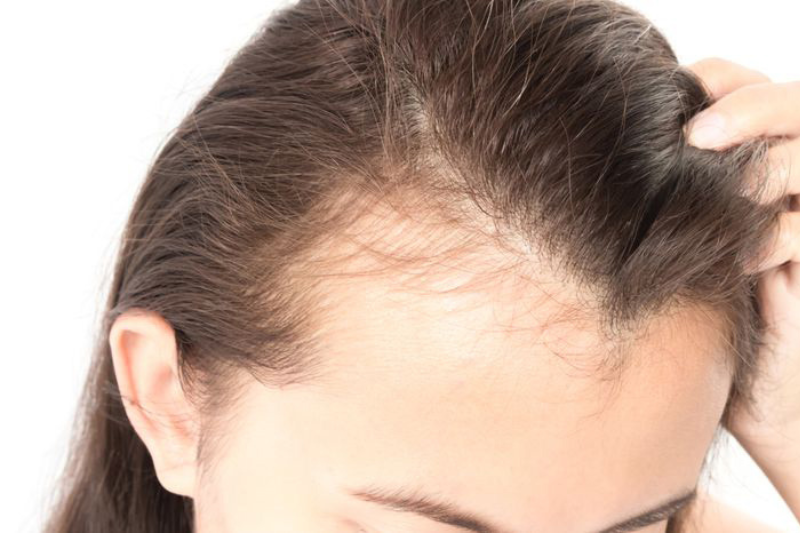 Rụng tóc sinh lý thường rụng một lượng nhất định, tóc mọc lại khỏe và không bị thưa