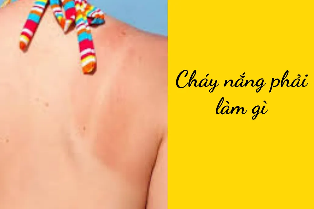 Cách chăm sóc da sau cháy nắng để hạn chế bong tróc và kích ứng