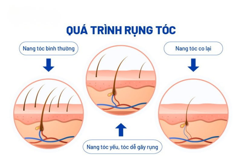 Giai đoạn rụng tóc