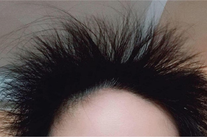 Chu kỳ mọc tóc là sự lặp lại không ngừng nghỉ