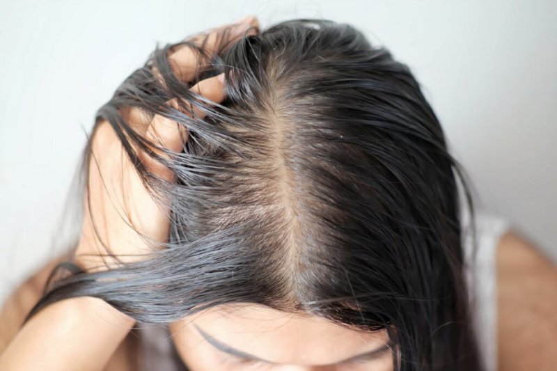 Mất cân bằng tuyền bã nhờn khiến da đầu dầu hơn