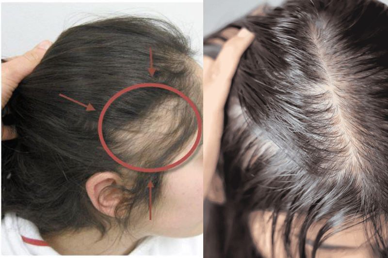 Buộc tóc quá chặt sẽ khiến nang tóc bị yếu, da đầu bị căng từ đó tóc sẽ rụng nhiều