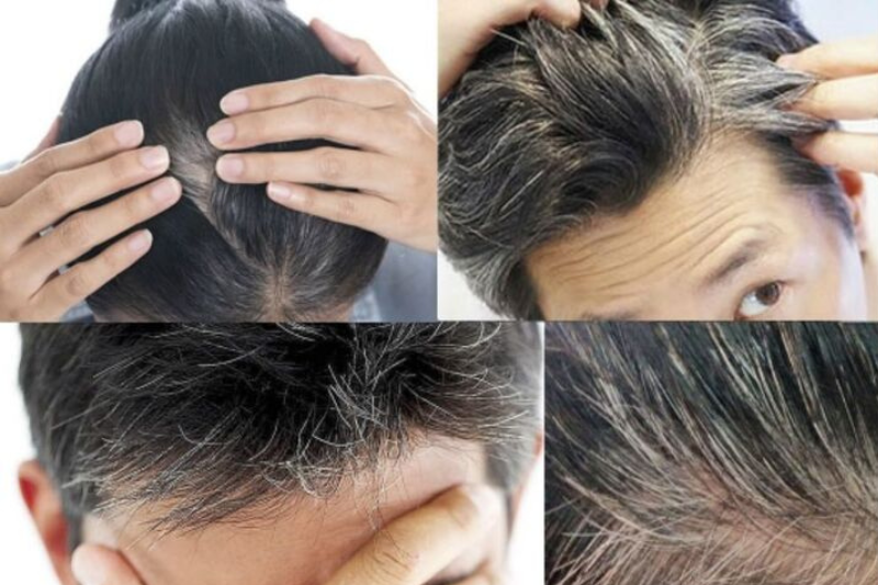 Tóc bạc sớm là hiện tượng tóc xuất hiện các sợi bạc khi bạn còn trẻ