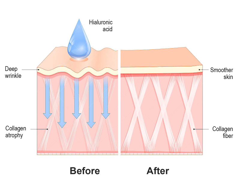 Collagen và Hyaluronic Acid kết hợp cùng nhau