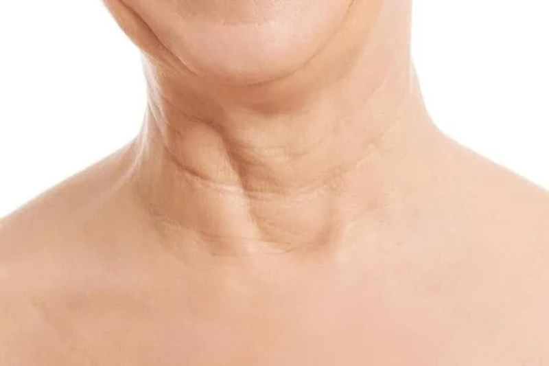 Vùng da cổ và ngực chảy xệ, có các đốm nâu cũng là dấu hiệu nhận biết tình trạng lão hóa