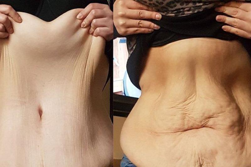 Collagen hỗ trợ giảm tình trạng da chảy xệ, chùng nhão khi giảm cân