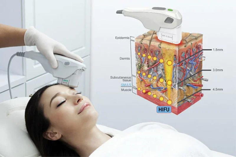Sử dụng công nghệ sóng HIFU giúp da căng mịn