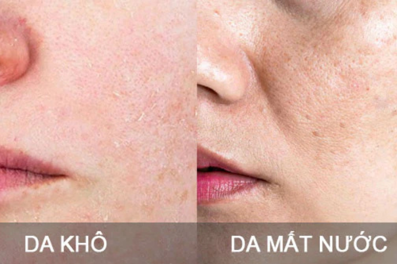 Da khô, thiếu nước thì có thể cấp ẩm để cải thiện